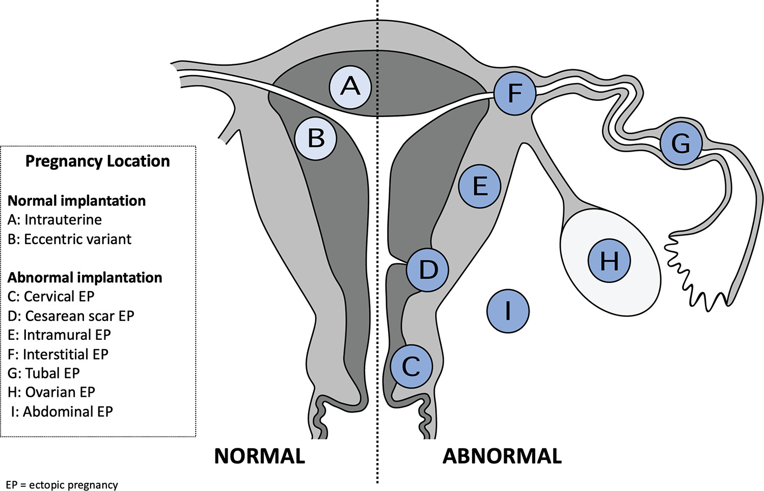 First Trimester US Lexicon Pregnancy Location Figure
