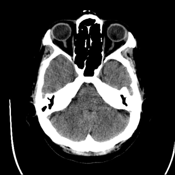 Axial CT - Lower Level