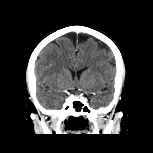 Coronal CT - Anterior Section