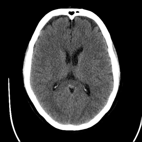 Axial CT - Basal Ganglia Level