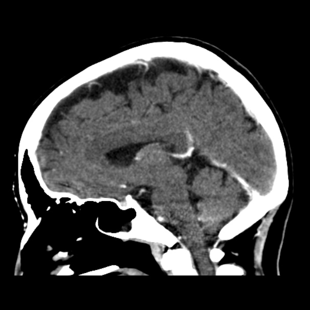 Sagittal CT - Midline