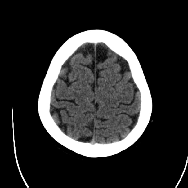 Axial CT - High Convexity